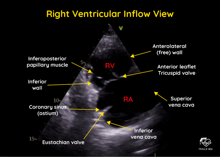Parasternal long axis view (PLAX) optimization : 네이버 블로그