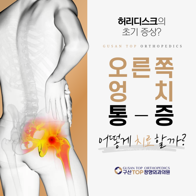 불광역정형외과 오른쪽 엉치 통증, 허리디스크 증상? 자세히 알아보기 : 네이버 블로그