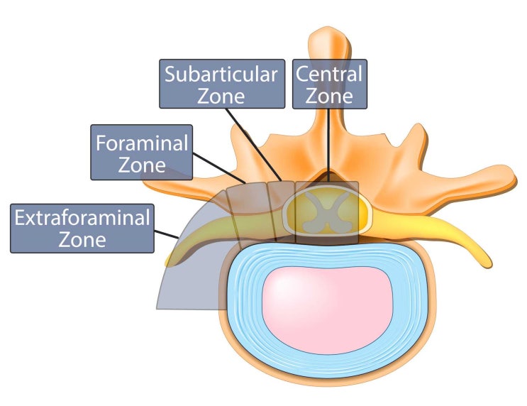 추간공 외측 허리디스크(Extraforaminal Lumbar Disc Herniation)란? : 네이버 블로그
