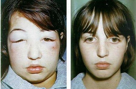 급성 사슬알균 감염후 사구체신염 PSGN APSGN 감기 이후 혈뇨 증상 원인 정의 치료 진단 : 네이버 블로그