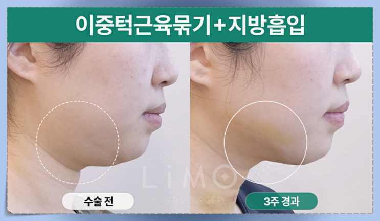 이중턱살제거수술 왜 필요할까? : 네이버 블로그