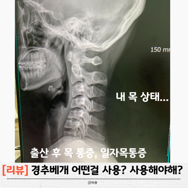 출산 후 목통증, 경추베개 효과 있을까? 일자목 솔직 사용후기 내돈내산 : 네이버 블로그