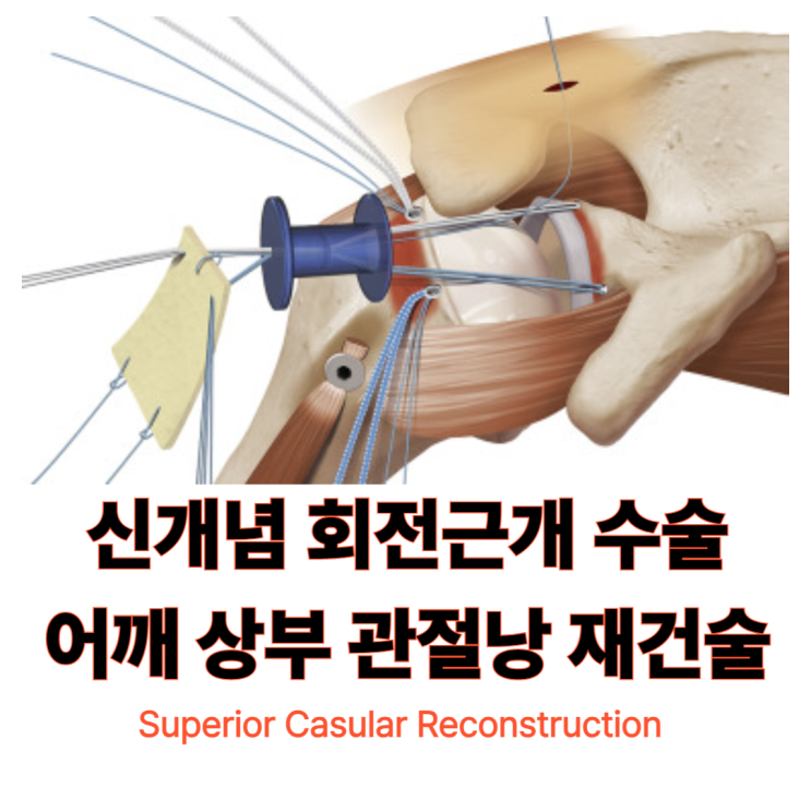 SCR(Superior Capsular Reconstruction/어깨 상부 관절낭 재건술) 수술과 재활 완벽 정리 : 네이버 블로그