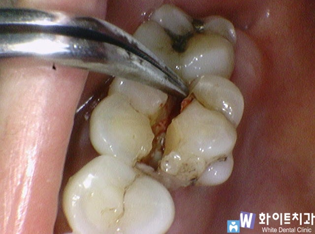 어금니치아파절 3791 : 네이버 블로그