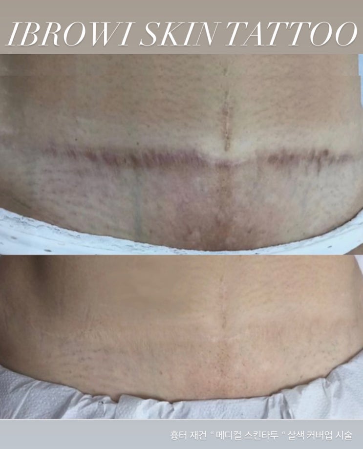 🩺 흉터 개선을 위한 주요 시술 방법 안내 = 메디컬 스킨타투 : 네이버 블로그
