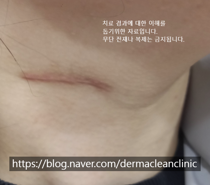목 수술흉터 비후성 반흔 울트라펄스 ( deep fx, cpg ) 치료기간은 얼마나 걸릴까? : 네이버 블로그