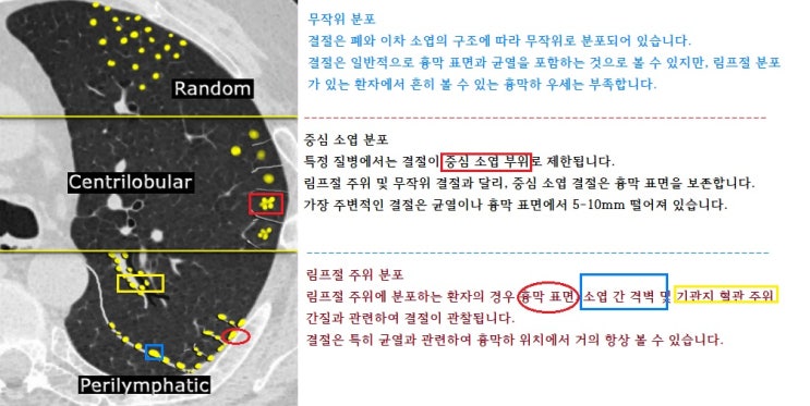 나의 폐CT 영상 진단 : 네이버 블로그