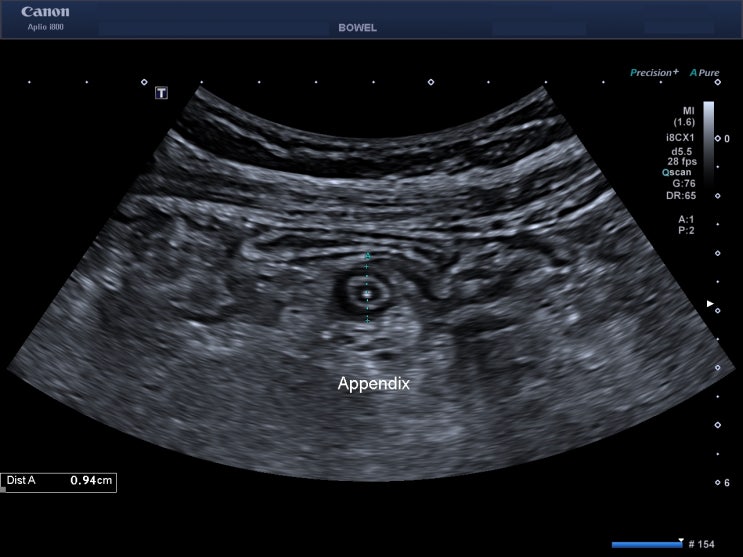 Appendicitis : 네이버 블로그
