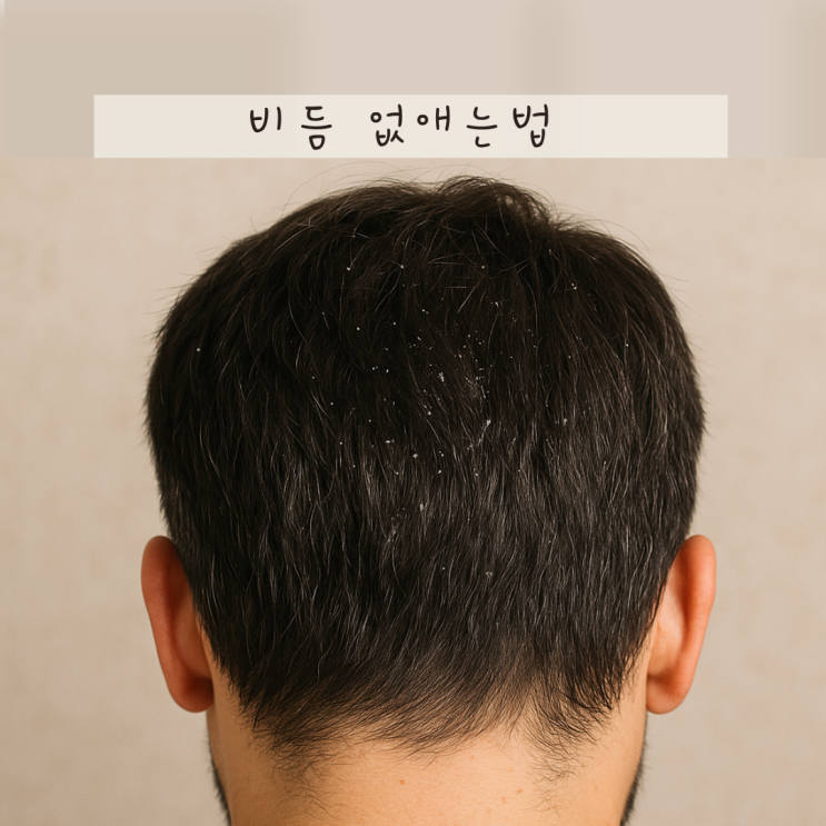 머리 두피 비듬 없애는 방법! 약 샴푸 생활습관까지 총정리