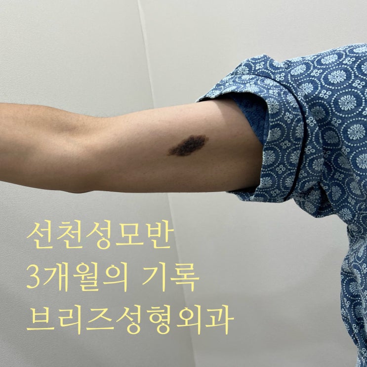 팔의 선천성모반 수술과정 및 흉터 - 브리즈성형외과 : 네이버 블로그