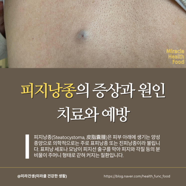 피지낭종(표피낭종) A to Z : 증상과 원인 치료와 예방 : 네이버 블로그