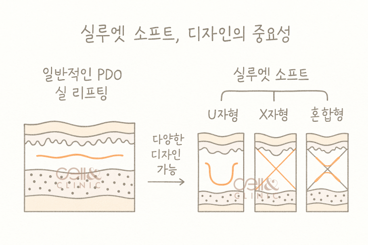 실루엣 소프트, 디자인이 결과를 좌우하는 리프팅의 핵심. 셀앤(Cell &)클리닉 : 네이버 블로그