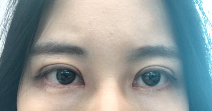 쌍커풀 수술 2주차 후기👀 (절개 눈매교정 + 앞트임 재수술) | 직장인 쌍수 리얼 후기 : 네이버 블로그