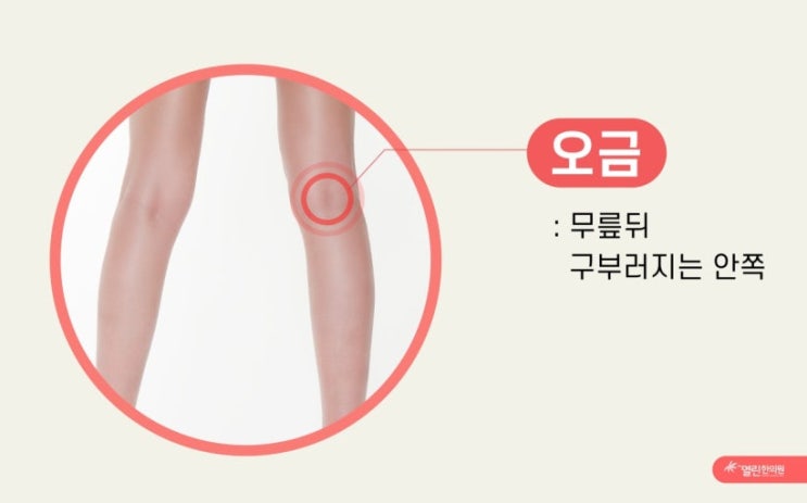 오금과 오금이 저리다의 뜻? ㅡ오금은 무릎 뒤 구부러지는 안쪽으로 오금이 저리다는 뜻은 긴장되거나 두려운 상황에서 다리가 ...