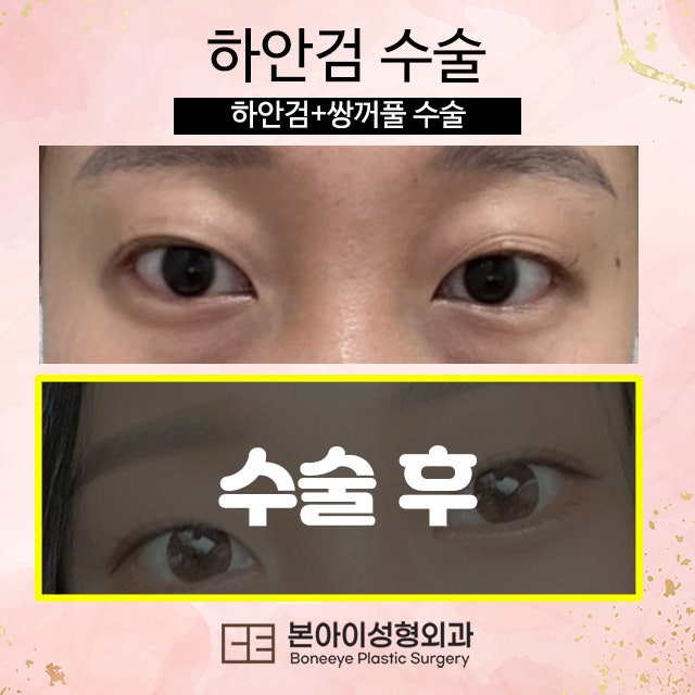 하안검수술흉터 후회없이 잘하는곳 선택한 이야기 : 네이버 블로그