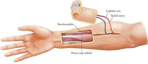 Radial forearm free flap (RFFF) 에서 사용하는 혈관 Radial artery 와 Cephalic ...