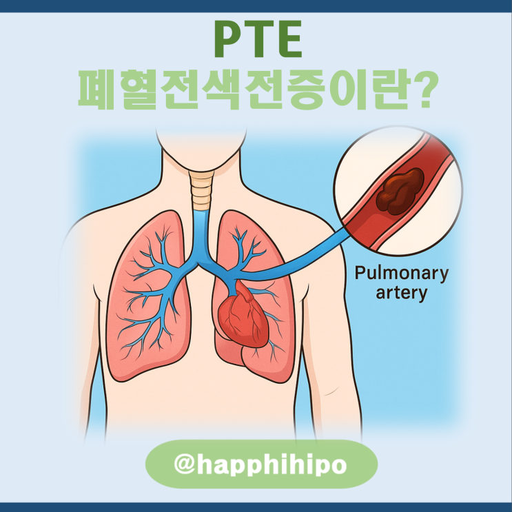 의학용어 PTE(폐혈전색전증)이란? 폐혈전증 증상, 진단, 치료, 치료 방법, 원인, 예방, 기본정보 총정리! : 네이버 블로그