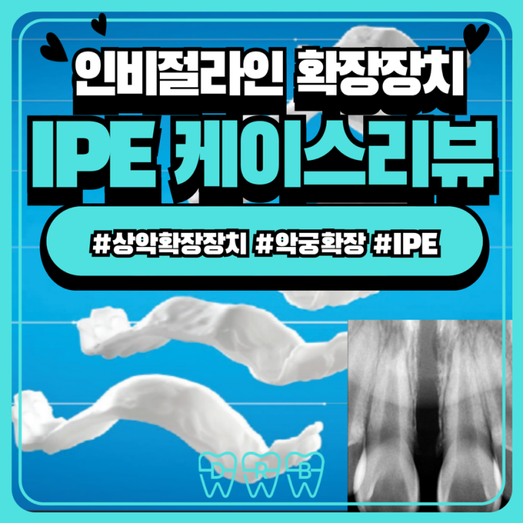 [닥터배 케이스 리뷰] IPE(인비절라인 악궁확장장치) | 악궁확장장치 비교 | 상악확장장치, RPE와의 차이점 | IPE 효과 ...