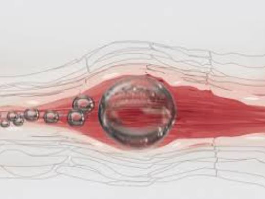 공기색전증(Air Embolism) │ 원인, 증상, 진단과 치료 방법 : 네이버 블로그