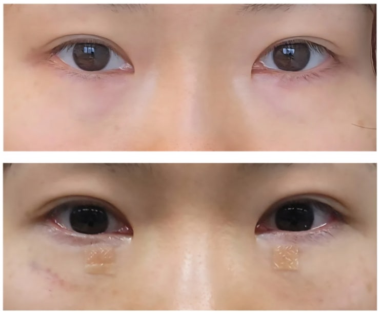 3년 고민한 앙코르 눈밑지 당일부터 일주일 후기 : 네이버 블로그
