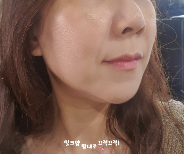 강남역 피부과 쳐진 턱살 울쎄라 200샷 시술 후기 : 네이버 블로그