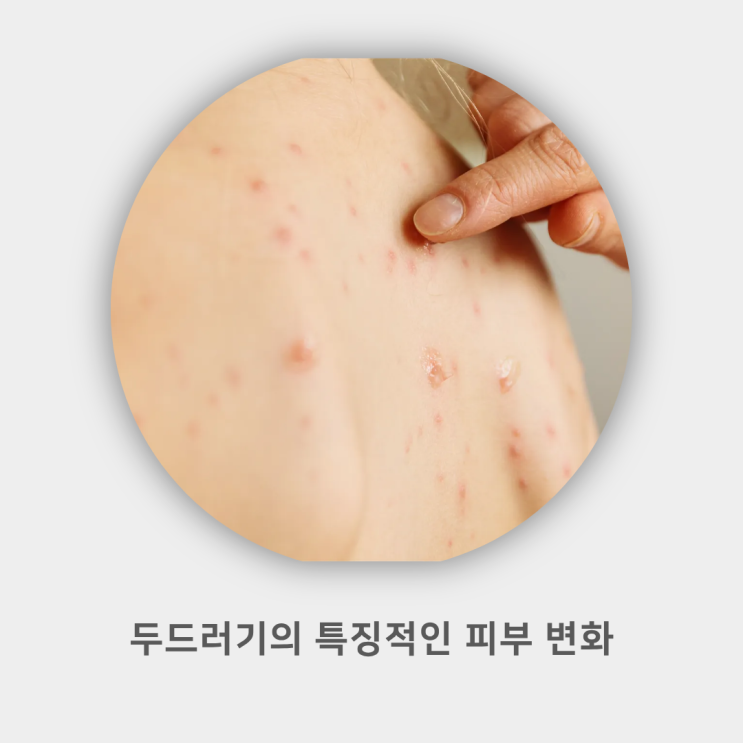 알러지 두드러기 증상, 간지러움 원인 : 네이버 블로그