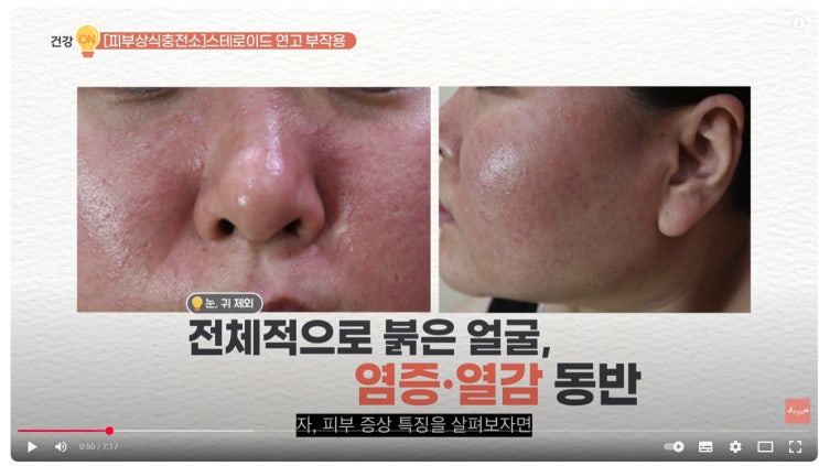스테로이드 연고 부작용과 해결법 ft.홍조, 모낭염, 피부상처, 자반 : 네이버 블로그