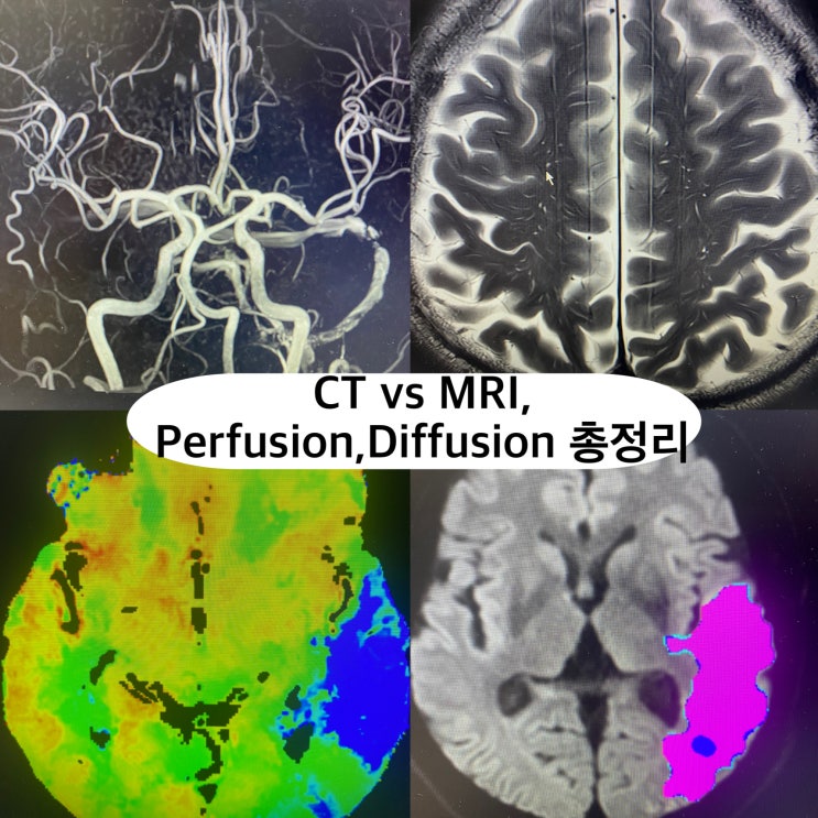 뇌질환 진단의 핵심, CT vs MRI, Perfusion,Diffusion 검사 차이와 선택기준 : 네이버 블로그