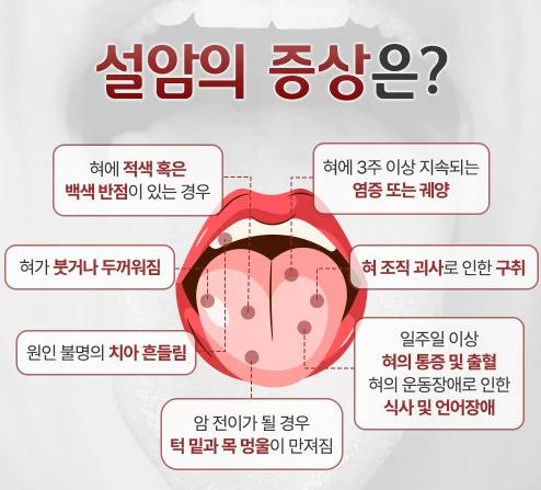 설암: 역사, 원인, 증상, 병기별 특징, 생존율 : 네이버 블로그
