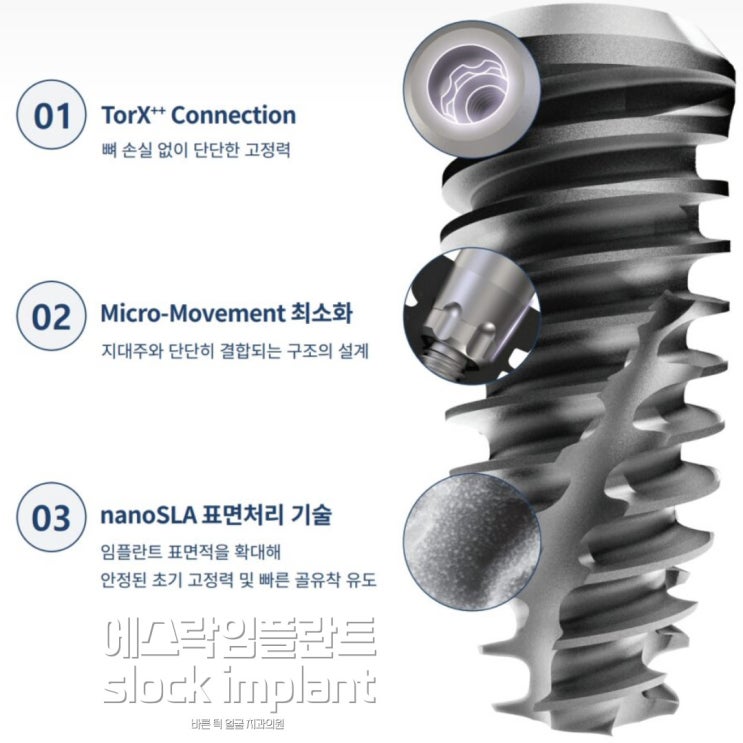 에스락 임플란트 :: slock implant 장점 : 네이버 블로그