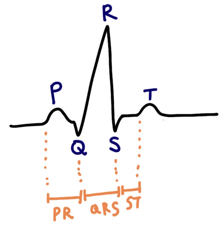 EKG 해석, 원인, 치료방법 (A.fib / Vf / VT / Asystole / Bradycardia / SVT / A ...