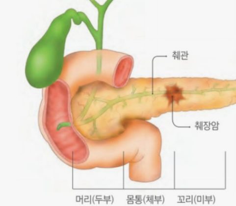 췌장 신경내분비종양/보험 진단금 : 네이버 블로그