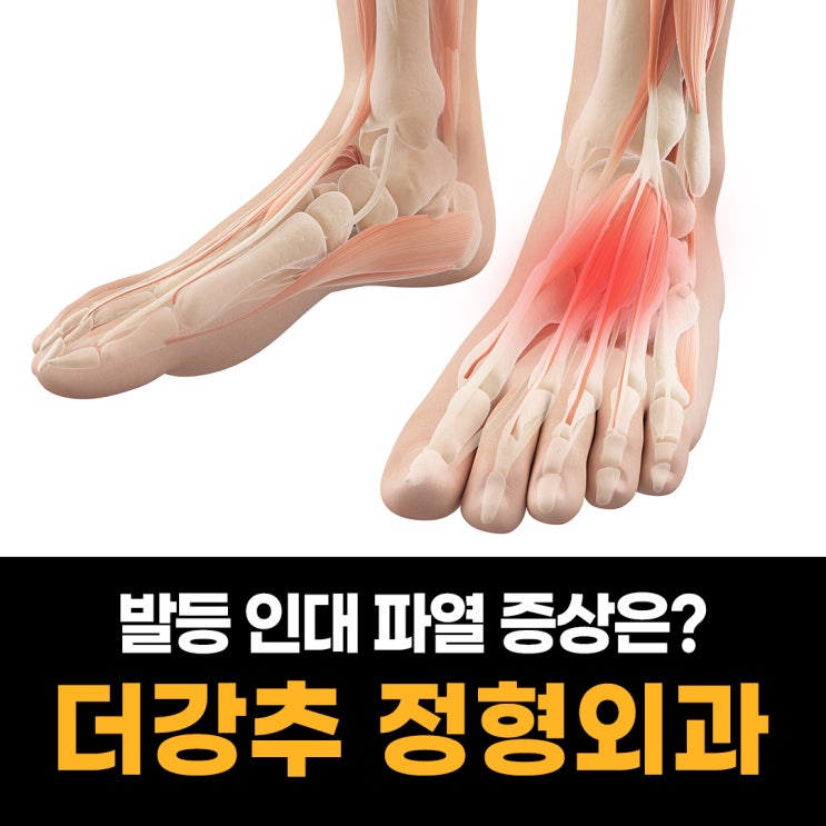 발등 인대 파열 : 발등에 통증, 부종, 멍 : 네이버 블로그
