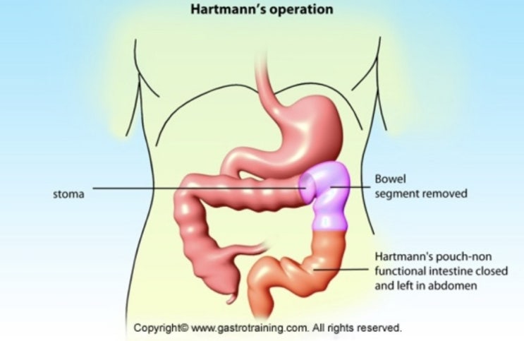 26-hartmann-s-procedure