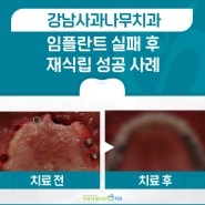 강남임플란트재수술, 또 실패할까 두려운 분들은 읽어주세요