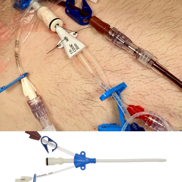 MAC Catheter란? 삽입적응증,위치,장점,관리방법,합병증 등 : 네이버 블로그