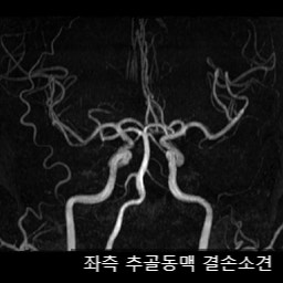 어지러워서 꼭 넘어질 것 같아요.(뇌경색, 소뇌) : 네이버 블로그