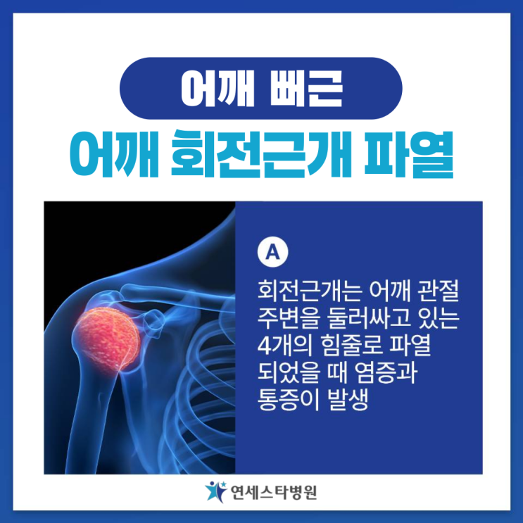 어깨 뻐근, 팔 올릴때 통증 회전근개파열 초기 증상 : 네이버 블로그