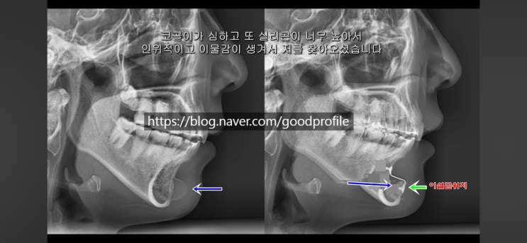 무턱수술 (코골이 동반 무턱) 치료 방법 - 보형물이 아니라 [이설근전진술 + 턱끝전진술(턱끝수술)] : 네이버 블로그