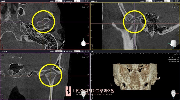 턱관절질환으로 인한 부정교합과 턱관절치과치료의 실손보험