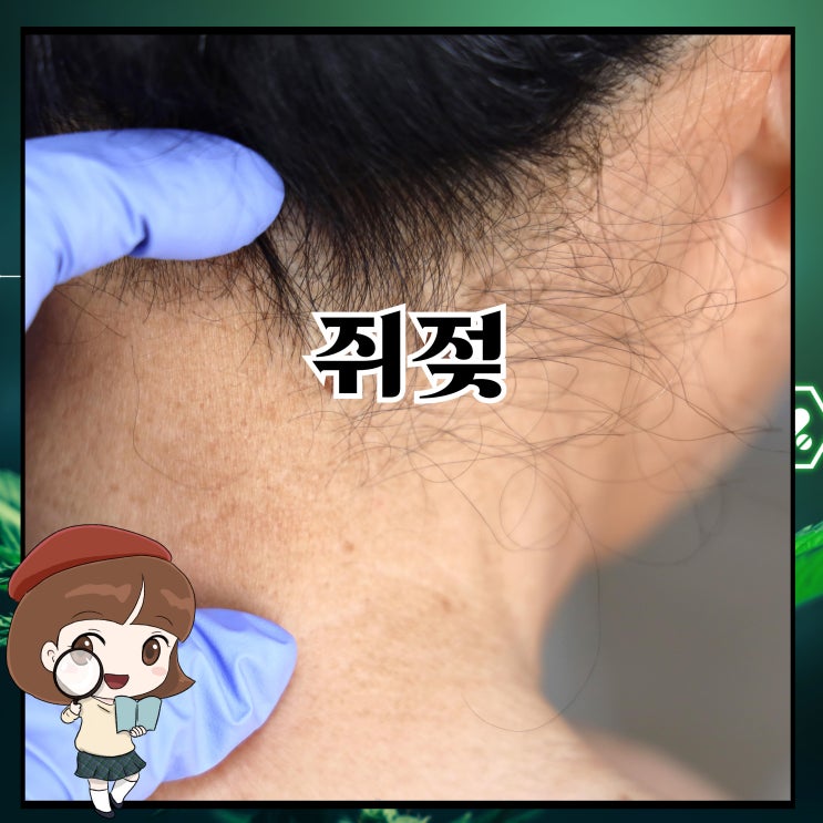 쥐젖 원인, 쥐젖제거 자기 관리와 민간요법 : 네이버 블로그