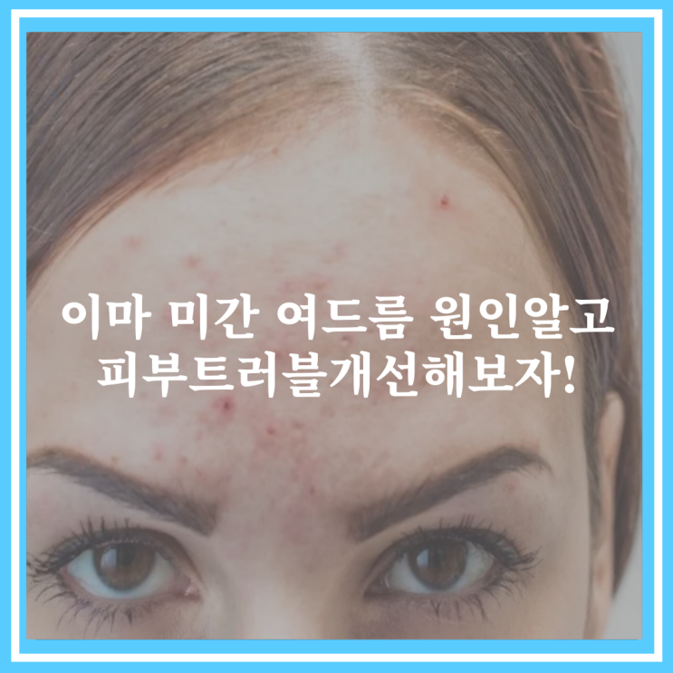 이마 미간 여드름 원인알고 피부트러블개선해보자! : 네이버 블로그