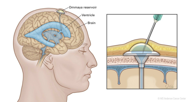 IT (Intrathecal) chemotherapy : 네이버 블로그