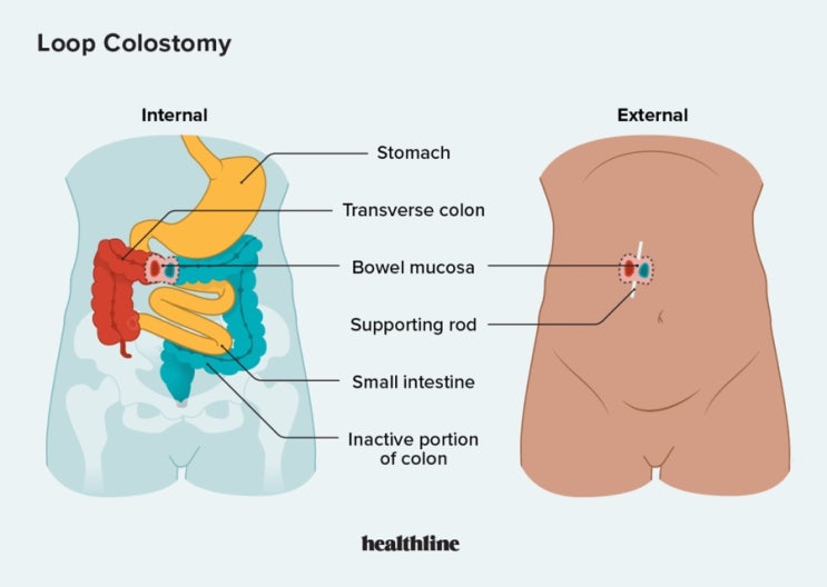 루프결장루(loop colostomy) : 네이버 블로그