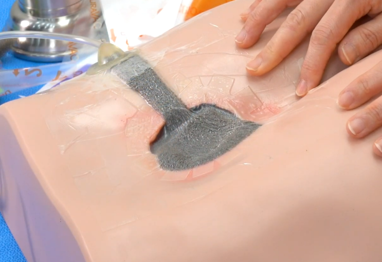 욕창치료 Vacuum Dressing- CGBio Curavac : 네이버 블로그
