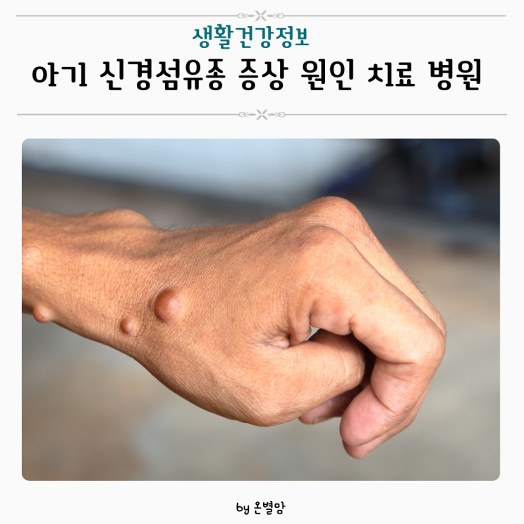 아기 신경섬유종 병원 증상 원인 치료방법 정리해봤어요 : 네이버 블로그