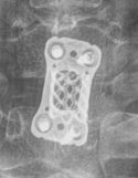 [척추심사]Corpectomy : 네이버 블로그