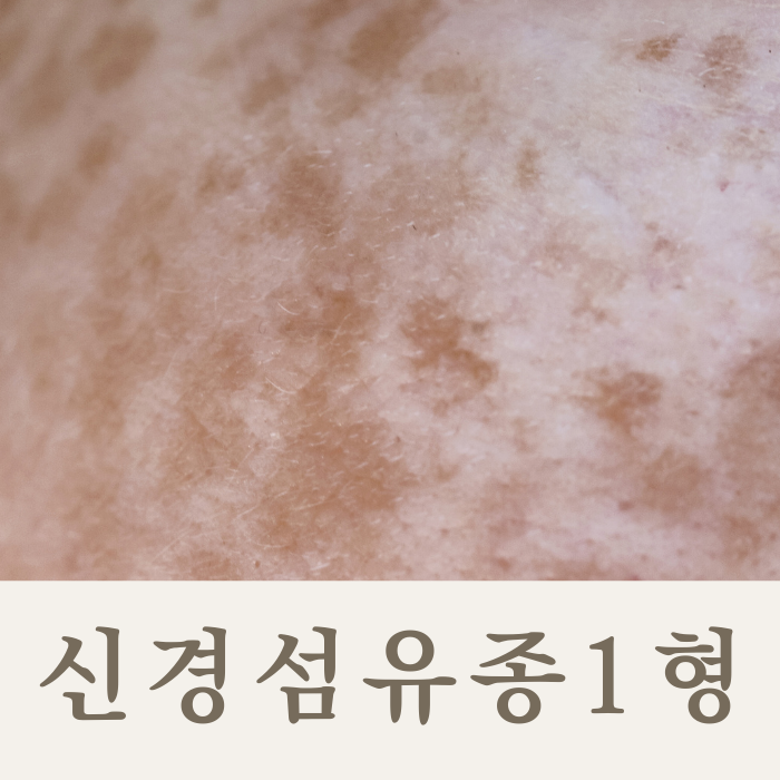 신경섬유종 1형 증상 및 원인 치료방법 : 네이버 블로그