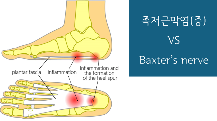 하남족저근막염 발바닥통증 Baxter's nerve entrapment 보듬한의 : 네이버 블로그