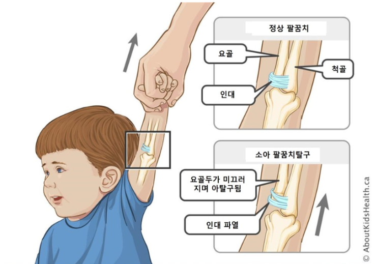소아 주관절 아탈구(pulled elbow) : 네이버 블로그